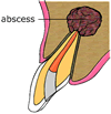 abscess