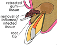 removal